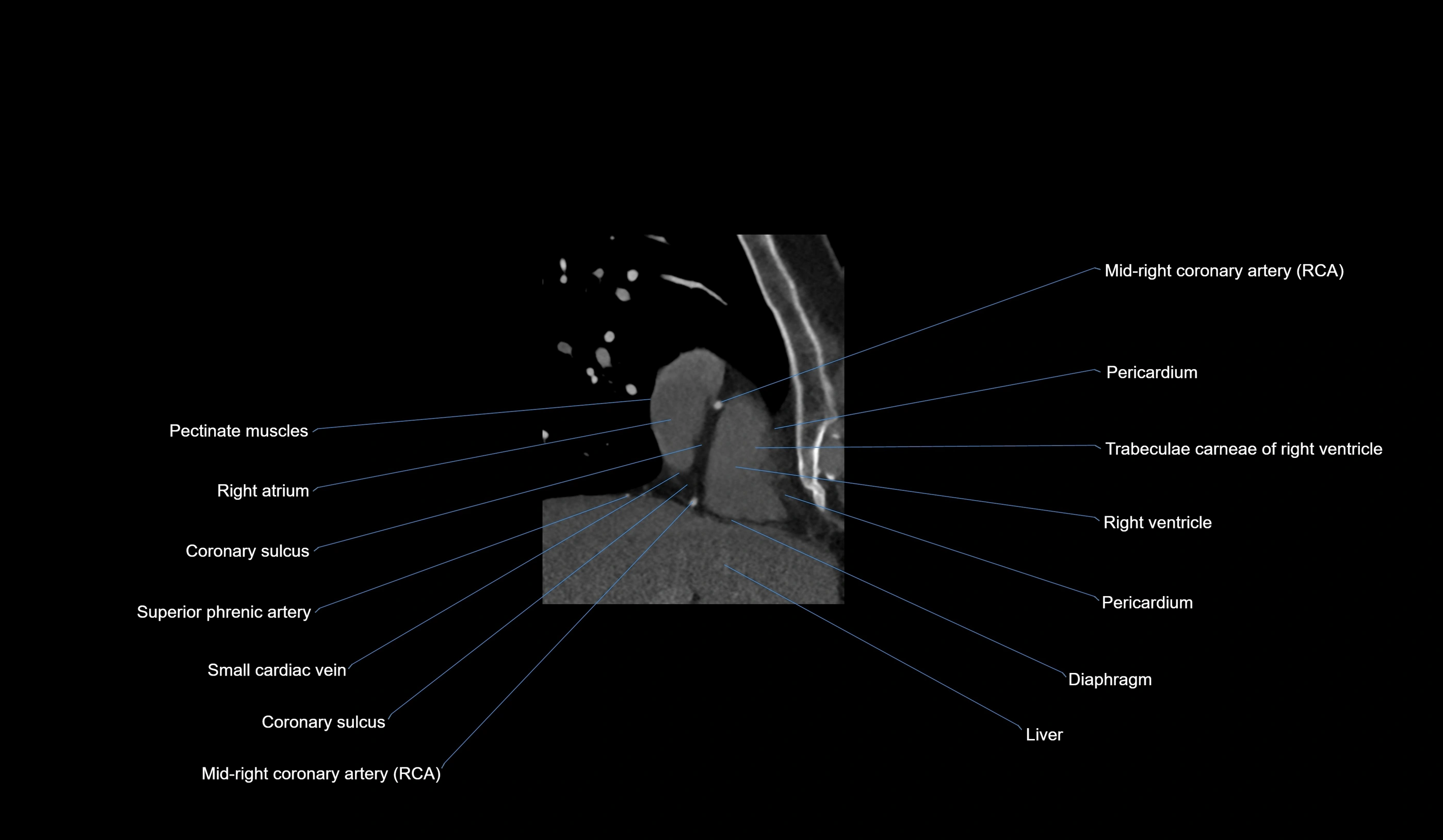 CT heart (coronary angiogram) 2 chamber view cross sectional anatomy labelled radiology image-00037.webp